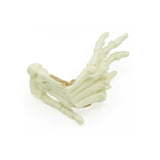 Forefoot Metacarpal Fx | Dog